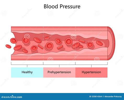 Blood Pressure Levels Diagram Medical Science Stock Illustration - Illustration of poster ...