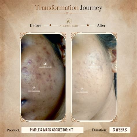 Pimple Skin Mega Brightening Kit | Ultimate Care for Clear & Glowing ...