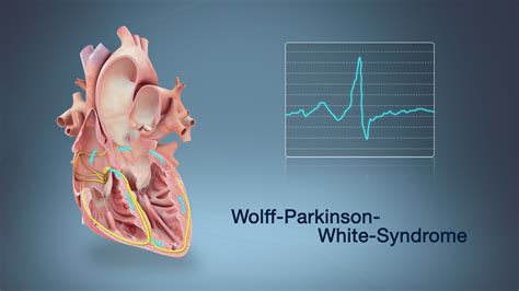 Wolff-Parkinson-White Syndrome Shown Using Medical Animation