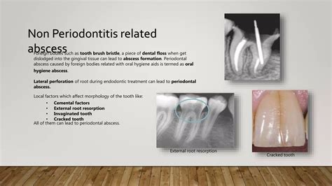 Abscess of periodontium | PPTX