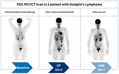 FDG-PET/CT in the Monitoring of Lymphoma Immunotherapy Response ...