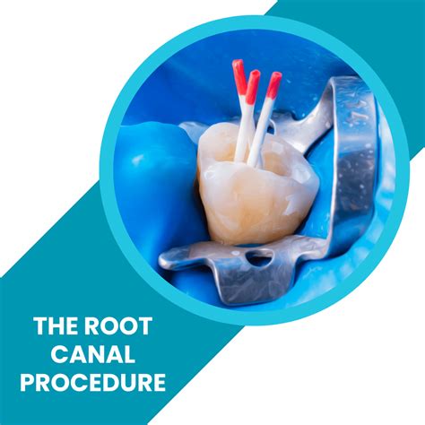 The Root Canal Procedure - How much is a root canal?