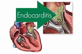 endocarditis 的图像结果