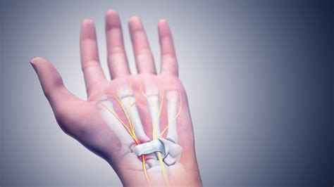 Carpal Tunnel Syndrome (CTS): Cause, Pathophysiology and Treatments