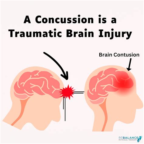 The Concussion Conundrum: The Missing Piece To Recovery — Rebalance Physical Therapy