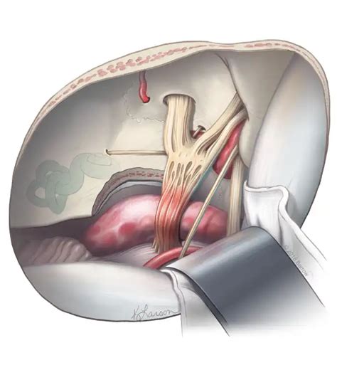 Image result for Microvascular Decompression Surgery
