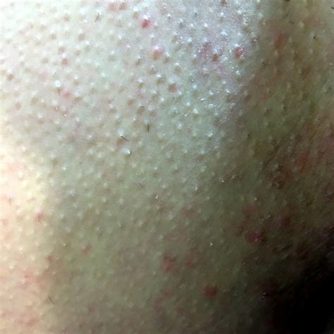 Picazón con ronchitas en tórax, glúteos, ingles y piernas – dermatologo.net