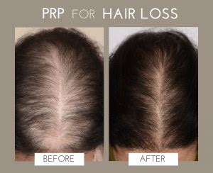 PRP Therapy | M A Skin & Hair Superspeciality Clinic - Dr. Manoj ...
