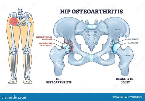 Osteoarthritis Illness Indicates Degenerative Joint Disease Royalty-Free Stock Image ...