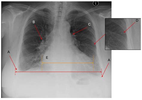 Diagnosing Lung Abnormalities Related to Heart Failure in Chest Radiogram, Lung Ultrasound and ...