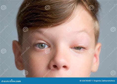 Insect Bite Eye Swelling Treatment at Harry Alvarenga blog