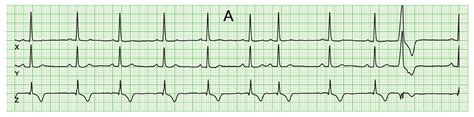 Intra-Individual Comparison of Sinus and Ectopic Beats Probing the ...