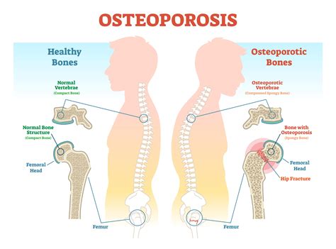 Can Osteoporosis Be Reversed