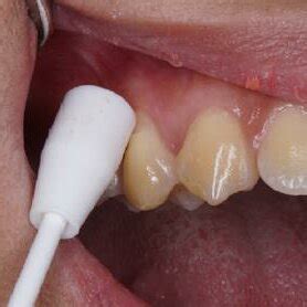 Infiltration Anesthesia 的图像结果