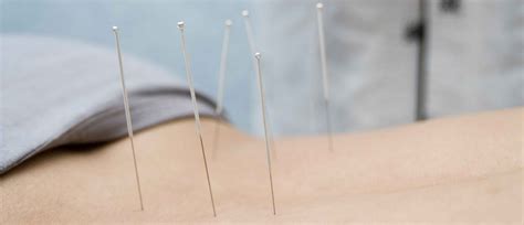 Dry Needing | The Backstory Chiropractic