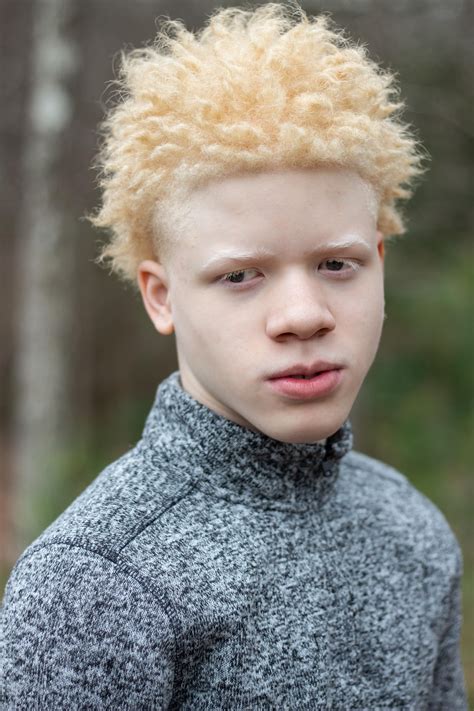 Albino Black Person
