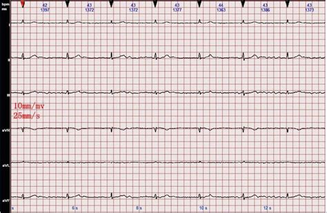 心电图图例分析16：心房颤动、三度房室传导阻滞、交界性逸搏心律_腾讯新闻