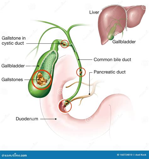 Gallstones In Gallbladder