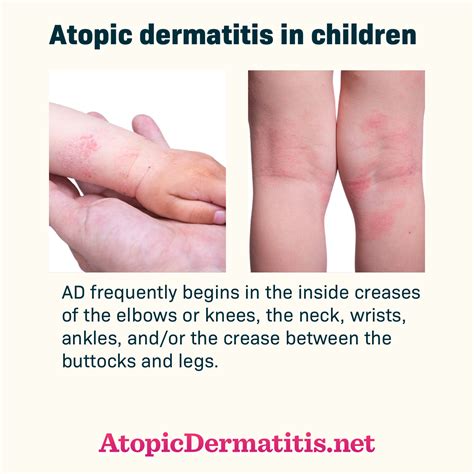 Atopic Dermatitis Images