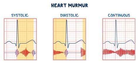 Mitral Insufficiency Murmur Sound Heart Murmur Harvard Health