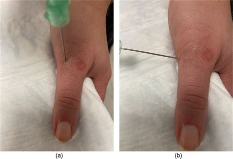 Digital Nerve Blocks: A Comprehensive Review of Techniques - Journal of ...