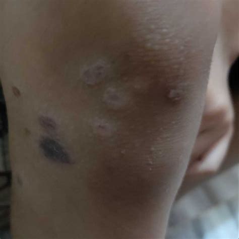 my kid has this type of pimples on his elbow,knees, fingers etc what to do ? treatment for this ...