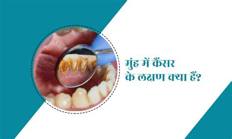 मुंह में कैंसर की तरफ इशारा करते हैं ये लक्षण - हैलो स्वास्थ्य