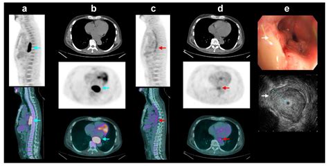 FDG PET/CT and Endoscopic Ultrasound for Preoperative T-Staging of ...