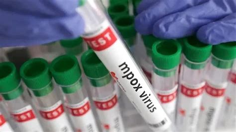 Karnataka Reports First Mpox Case of 2025: Dubai Returnee Tests ...