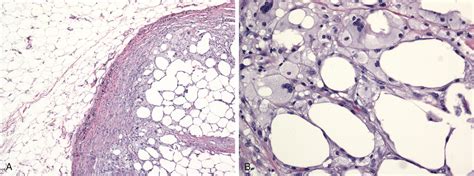 Reactive and Inflammatory Conditions of the Breast - Clinical Tree