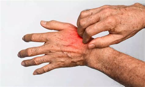 Delgocitinib Cream found Effective for Chronic Hand Eczema in Phase 3 trial