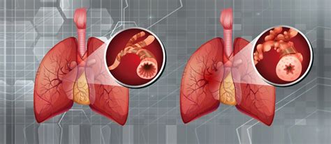 Chronic Obstructive Pulmonary Disease (COPD) | Ailments - MGMCH, Jaipur