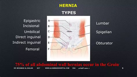 Hernia Repair: Open or Laparoscopic? | PPTX