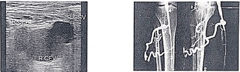 Varicose Veins - Medical Science Optional Notes for UPSC PDF Download