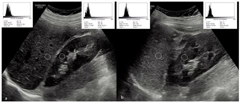 Evaluation of Hepatic/Renal and Splenic/Renal Echointensity Ratio Using Ultrasonography in ...