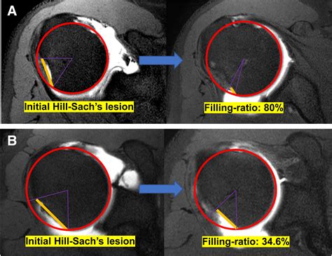Remplissage in Addition to Arthroscopic Bankart Repair for Shoulder ...