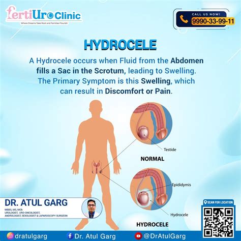 Hydrocele: a painful buildup of fluid around testicles | Dr Atul Garg posted on the topic | LinkedIn - fluid in testicles