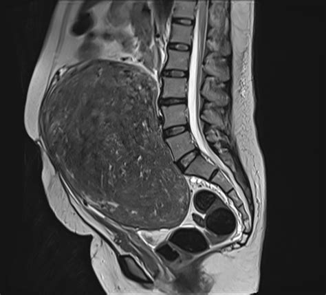 Can Fibroids Cause Lower Back Pain?| Fibroid Lower Back Pain