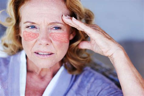 Lupus Linked to Higher Risk of 16 Types of Cancer, New Study Says