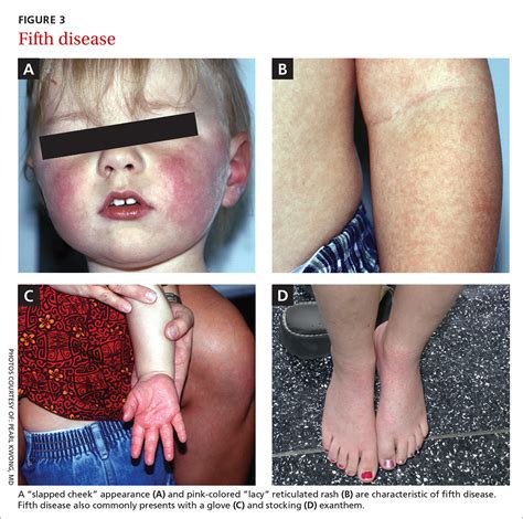Reticular Rash Fifth Disease