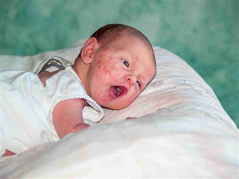 Everything You Should Know About Congenital Rubella Syndrome