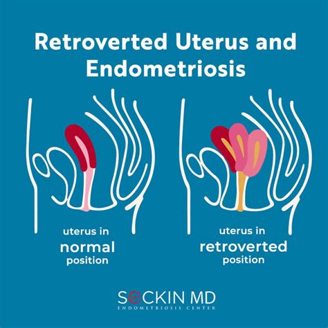 Retroverted Uterus Does It Affect Pregnancy