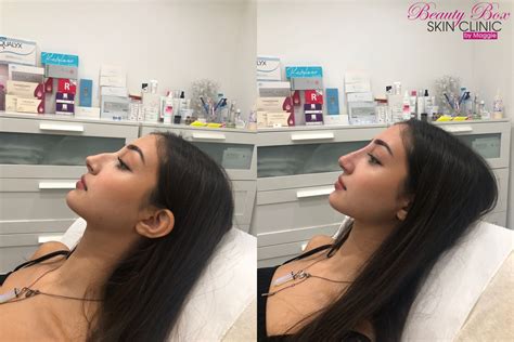 Liquid Rhinoplasty | Rhinoplasty nose jobs, Nose job, Nonsurgical nose job