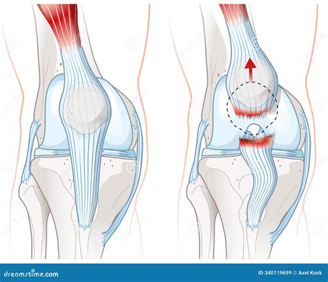 Unlabeled Patella CrossFit | Bones Of The Knee