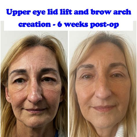 Surgery for Droopy Eyelid: 5 Things You Need to Know