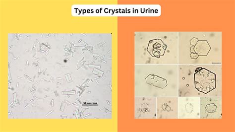 Cholesterol Crystals In Urine