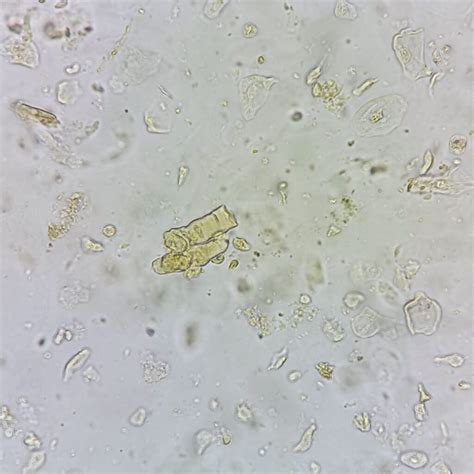 Waxy Casts: Identification & Significance - MedLabBuddy