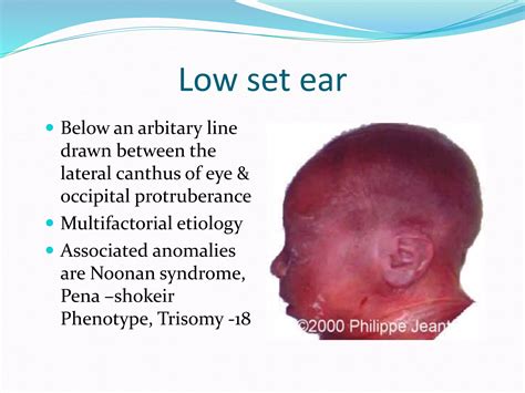 EMBRYOLOGY AND MALFORMATION OF EAR | PPTX