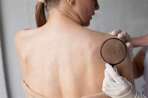 Step-by-Step Guide: Remove skin tags dermatologist approved