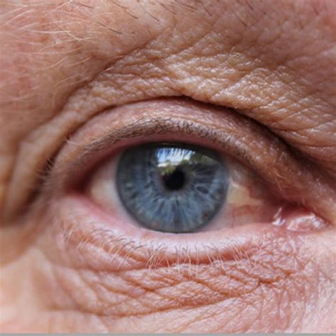 What is Age related macular Degeneration? | Dr. Manisha Agarwal